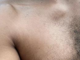 negrodovitiligo
